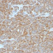 FFPE human melanoma sections stained with 100 ul anti-Bcl-2 (clone BCL2/796) at 1:300. HIER epitope retrieval prior to staining was performed in 10mM Tris 1mM EDTA, pH 9.0.
